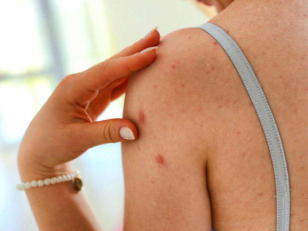 Alertan por la detección de un posible caso de sarampión