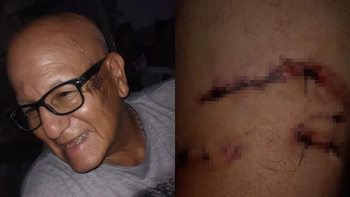 Lomas de Zamora: un hombre de 75 años fue atacado y desfigurado por tres perros