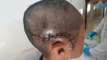 Terrible accidente filmado en Ezeiza: lo atropelló un colectivo y perdió parte del cráneo