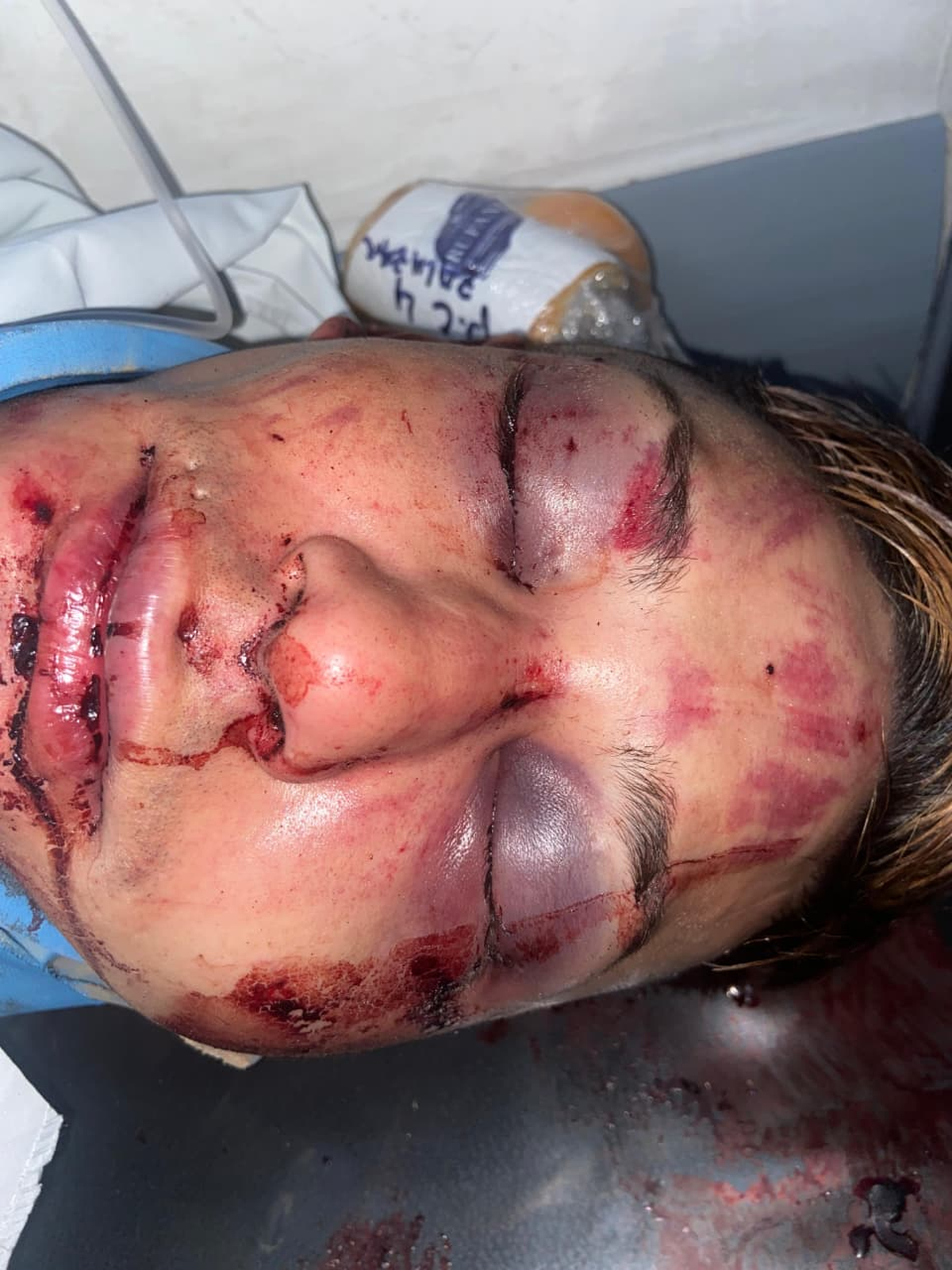 El hombre sufrió graves lesiones en su rostro. 