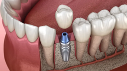 conoce todo lo que pueden lograr los implantes dentales