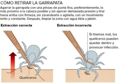 Proceso para retirar correctamente la garrapata transmisora de Lyme.