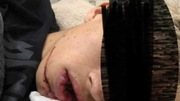 un joven de 19 anos sufrio una fractura de mandibula tras una brutal golpiza en un boliche
