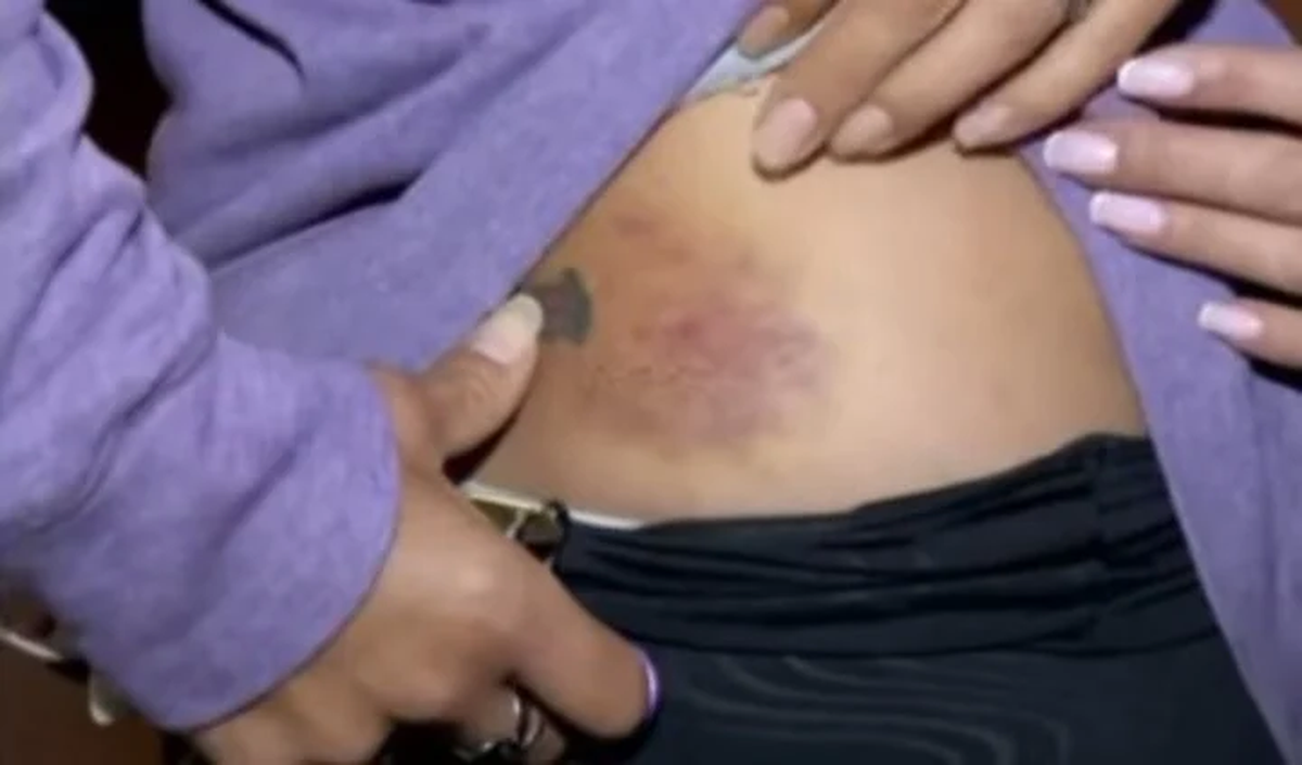 Las heridas de Adriana tras ser atropellada por un auto en Lanús.