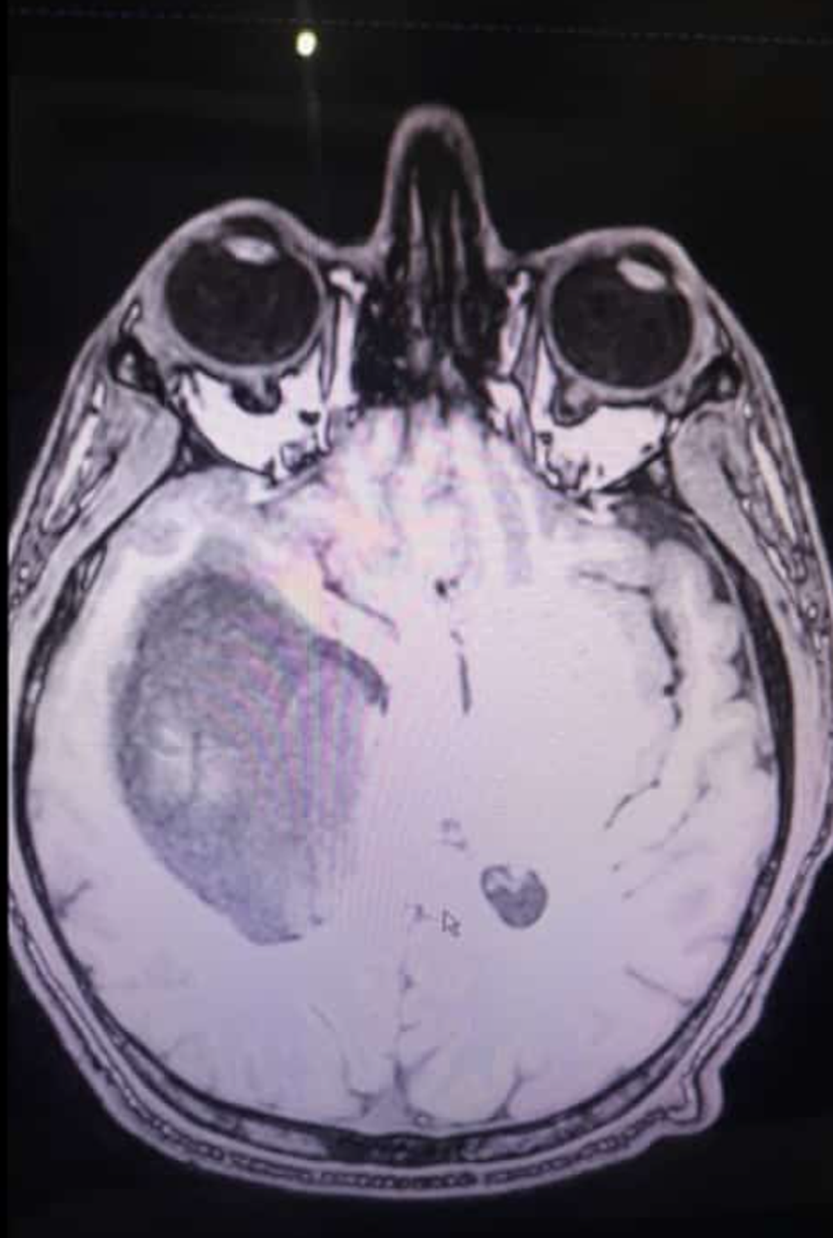 El tumor medía 12 centímentros.