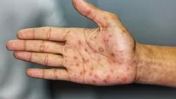 crecen los contagios de sifilis en buenos aires: esteban echeverria refuerza los testeos y la prevencion