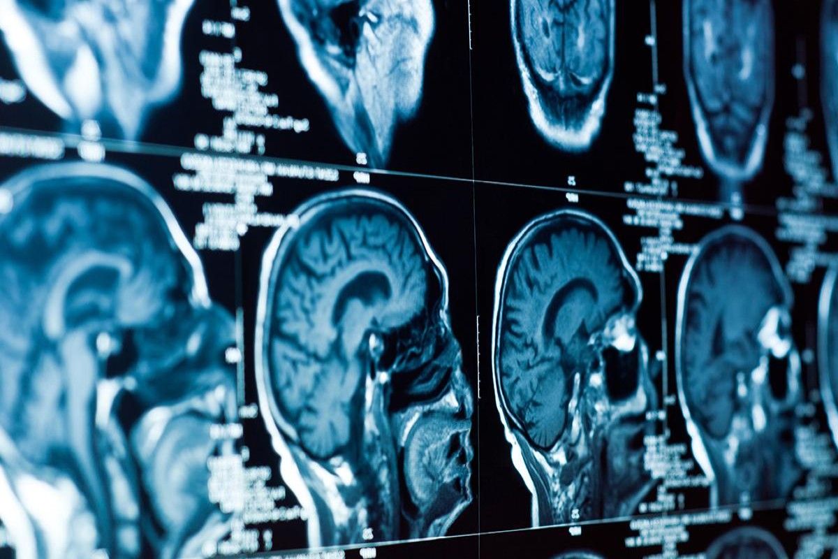CIDI destaca la importancia de la neurorradiología para la detección temprana de enfermedades