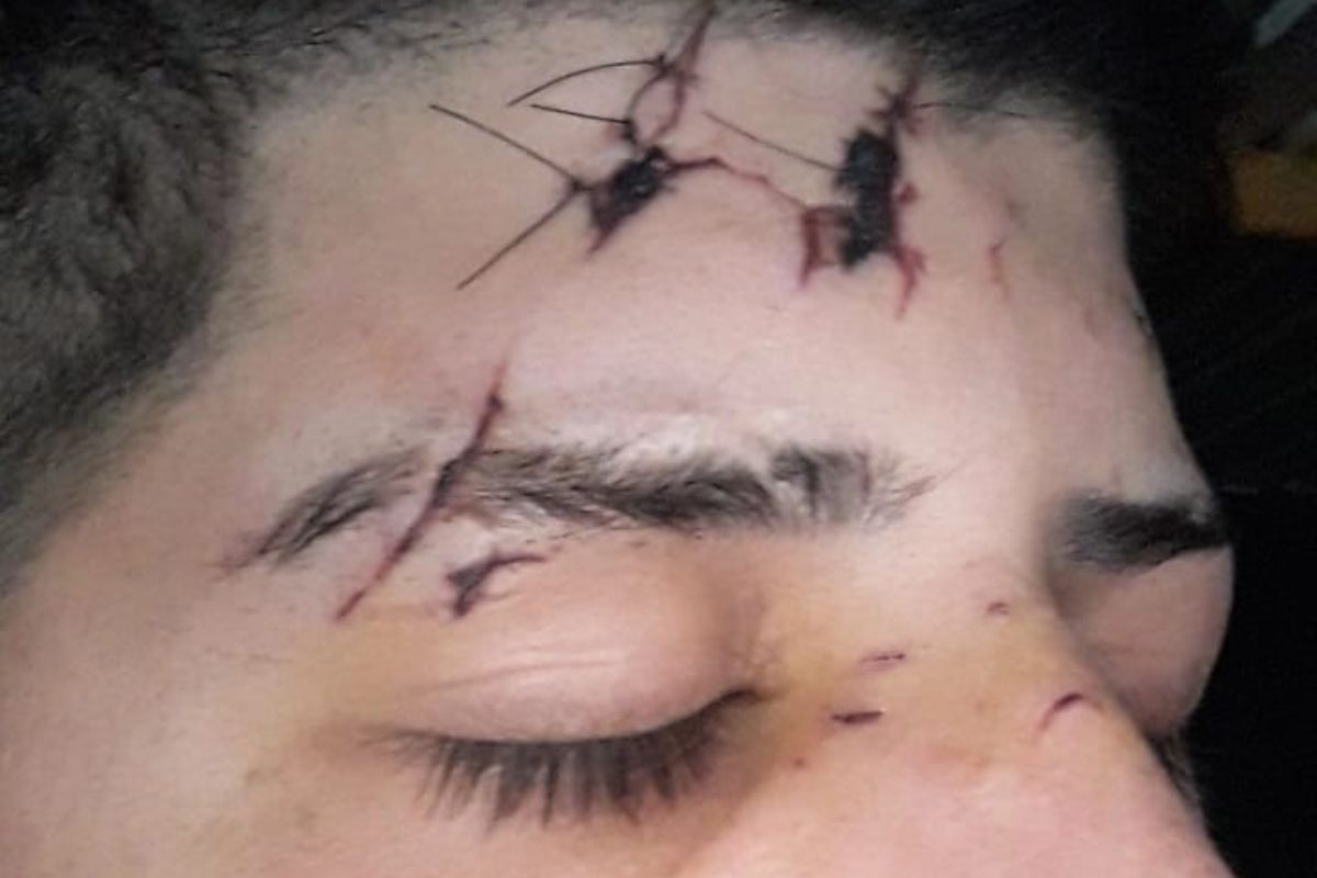 Un joven de Brown sufrió una golpiza en un boliche de Quilmes y quedó comprometida su vista